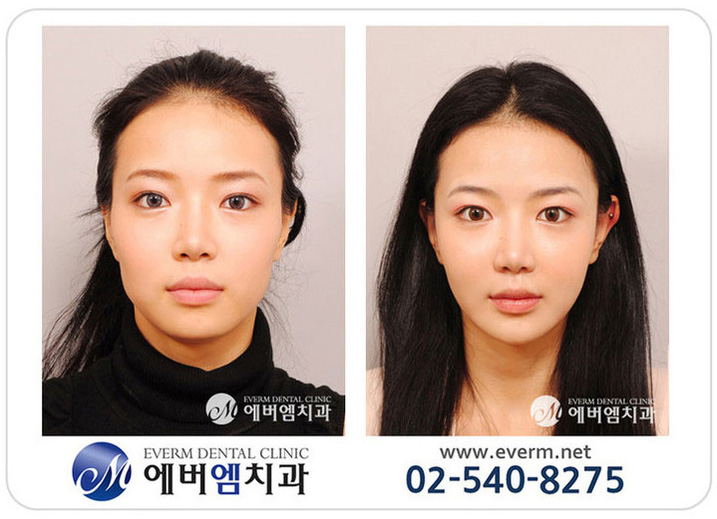[사각 턱] 사각턱보톡스 시술.. : 네이버 블로그