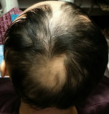 NK두피클리닉 이미지